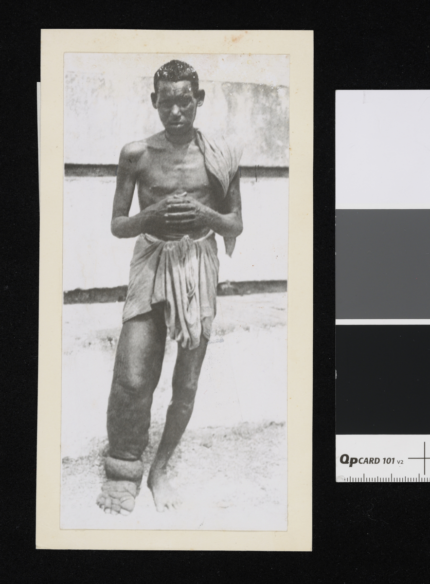 Mann med Elefantiasis. Fotografi samlet i forbindelse med Elisabeth Meyers reise til India 1932-33.