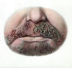 Illustrasjon av ansiktsrosen