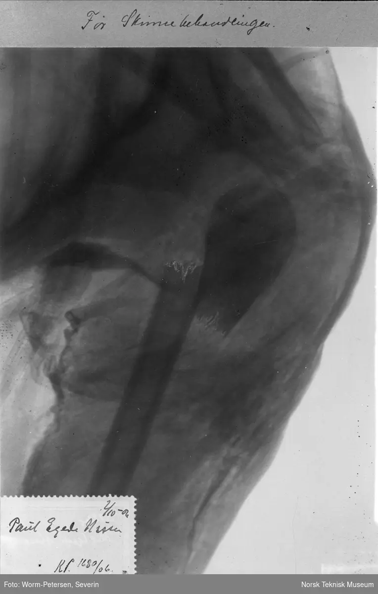 Røntgenbilde av brukket overarmsben, før skinnebehandling.