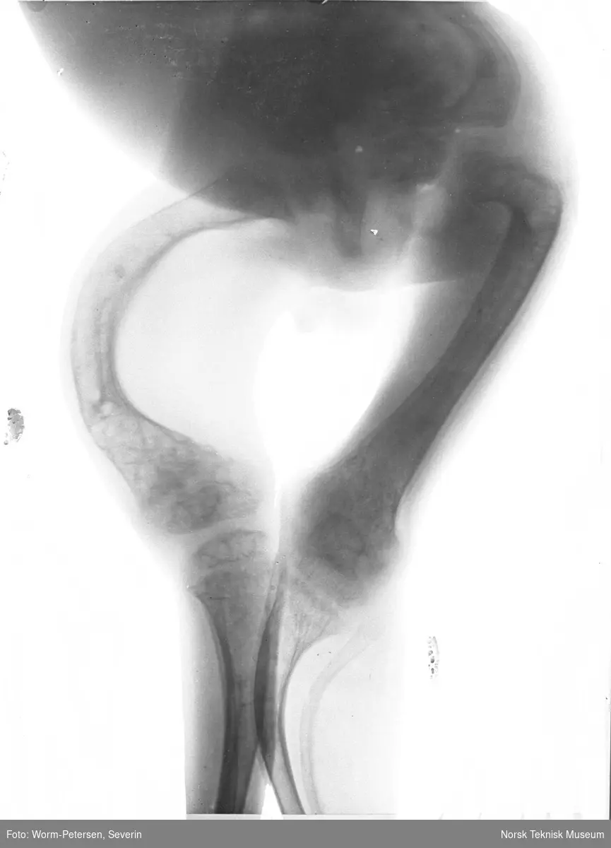 Røntgenbilde av kalvbent barn.