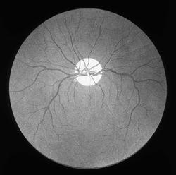 Anatomi; Øyet. Øyebunnbilde.