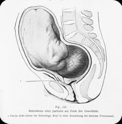 Avfotografert tegning av en delvis bakoverbøyd livmor, retro