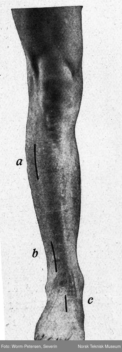 Medisinske illustrasjoner, kirurgiske instrument 1928 (legg, fot)